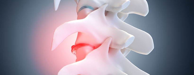 patient needing Degenerative Disc Disease in need of Spinal Decompression Therapy in Sacramento