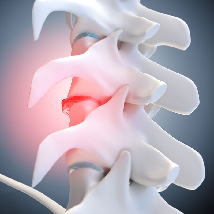 degenerative Disc Disease treatment in Sacramento