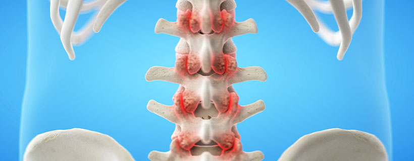 patient needing Facet Joint Syndrome in need of Spinal Decompression Therapy in Sacramento