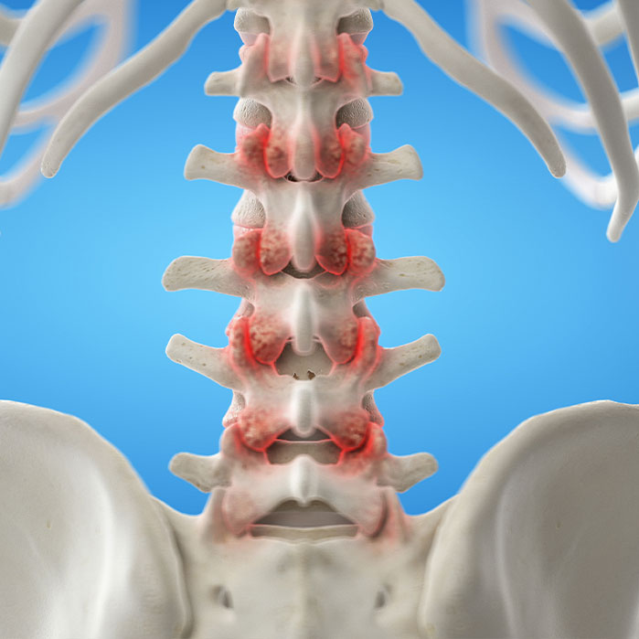 facet Joint Syndrome treatment in Sacramento