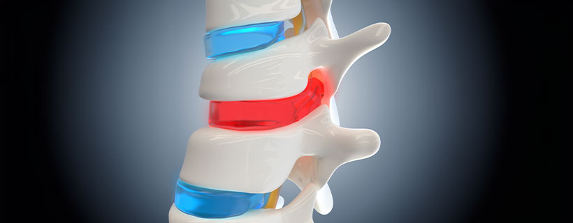 patient needing herniated disc in need of Spinal Decompression Therapy in Sacramento