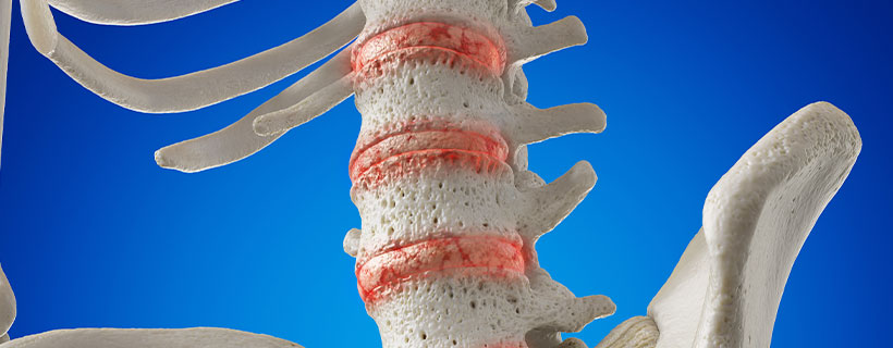 patient needing osteoarthritis in need of Spinal Decompression Therapy in Sacramento