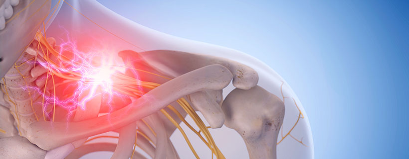 patient needing pinched nerve in need of Spinal Decompression Therapy in Sacramento