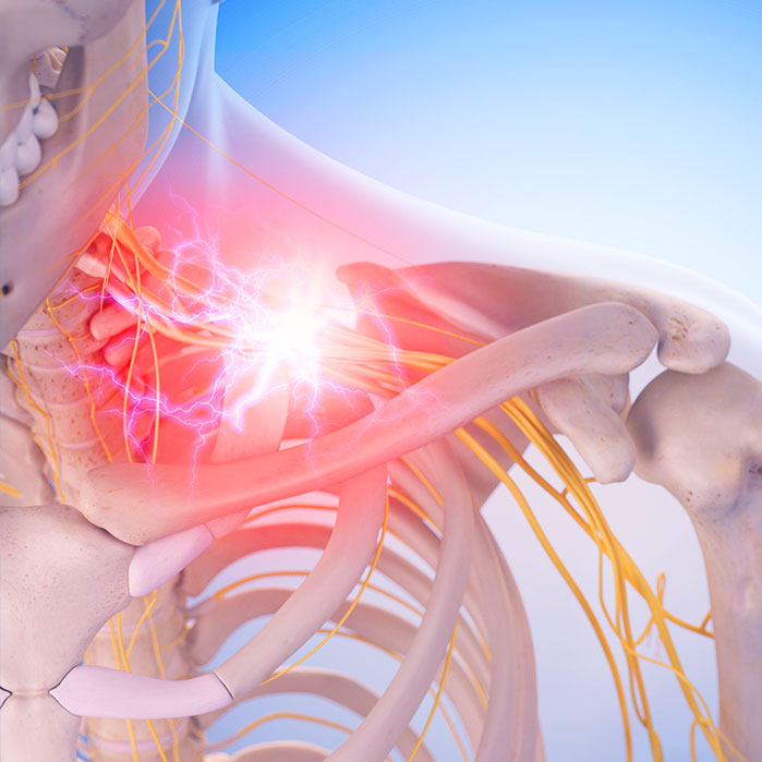 pinched nerve treatment in Sacramento