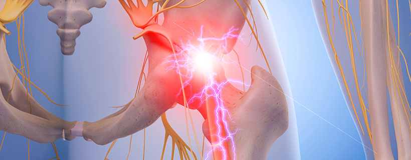 patient needing sciatica in need of Spinal Decompression Therapy in Sacramento