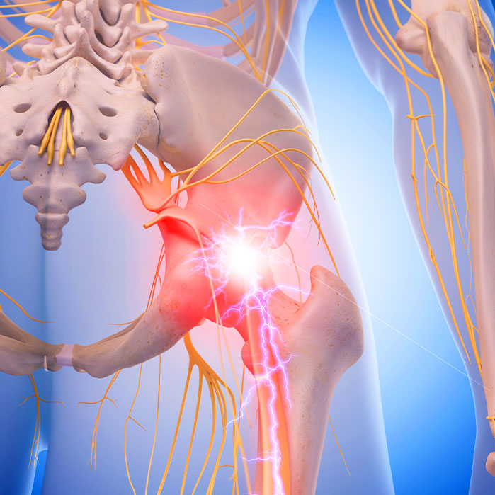 sciatica treatment in Sacramento