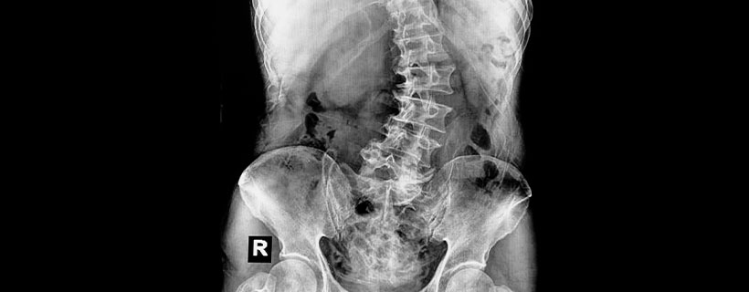 patient needing scoliosis in need of Spinal Decompression Therapy in Sacramento