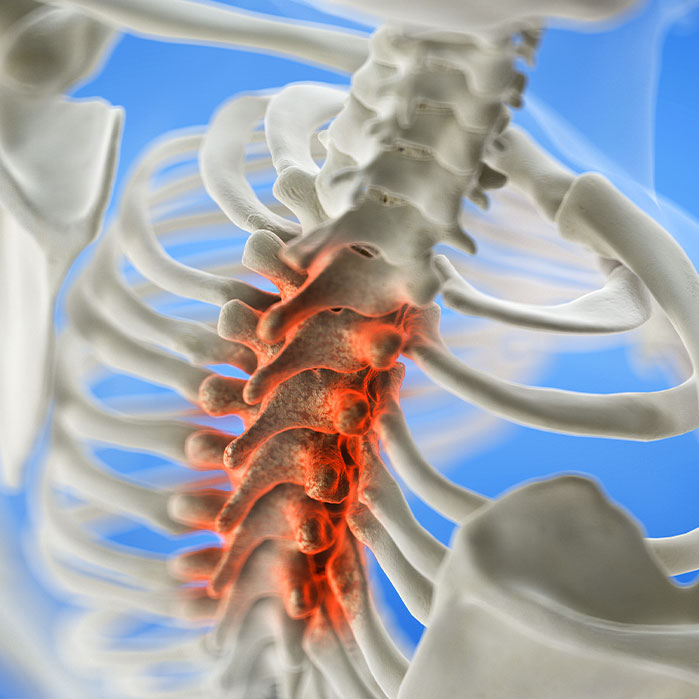 spinal Stenosis treatment in Sacramento