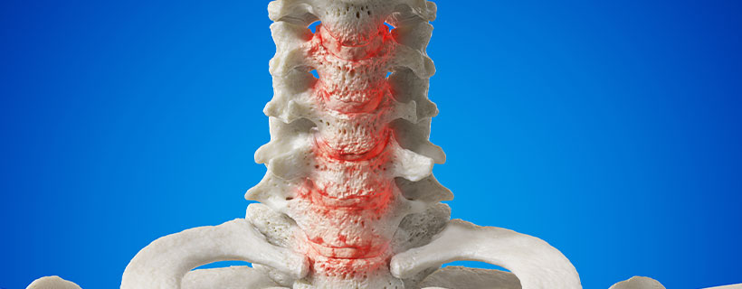 patient needing Spondylosis in need of Spinal Decompression Therapy in Sacramento