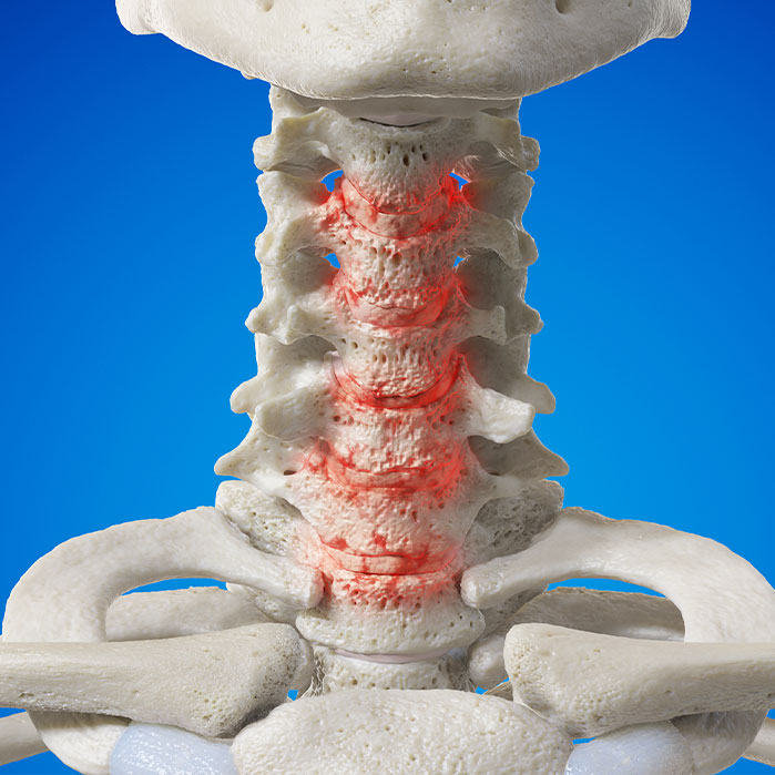 spondylosis treatment in Sacramento
